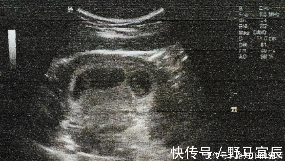 孕妇|怀孕后,身体出现这5种反应,可能是“胎停育”,孕妇要立即就医