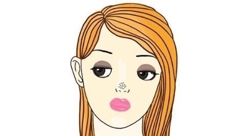 鼻子上黑头多怎么办，这样做让你告别“草莓鼻”