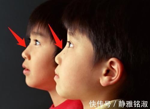 鼻梁|从小给孩子“捏鼻梁”,长大后鼻子会不会“变高”?父母知道为好