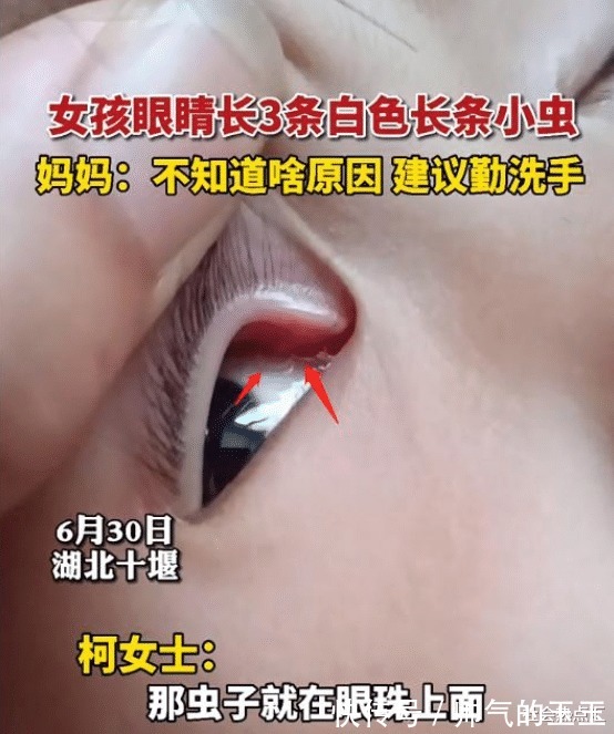 女童|2岁女童眼中取出3条白虫,妈妈误以为是眼屎,吓得不轻