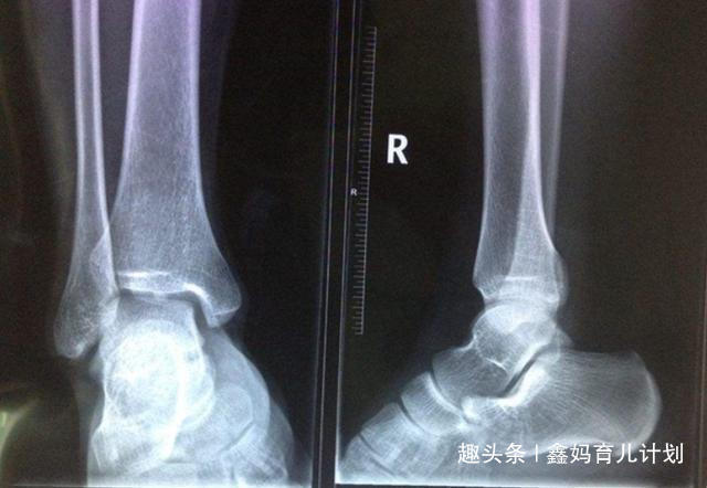 身高|“骨骼闭合”前,身体会发出3信号,家长及时发现身高还能窜一窜