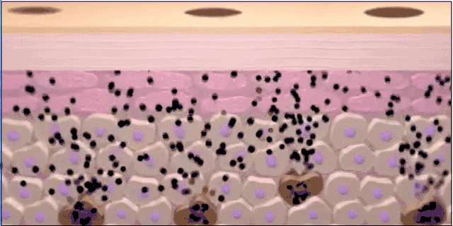 反黑 做完光子嫩肤之后反黑了怎么办呐?什么是反黑?术后该如何护理?