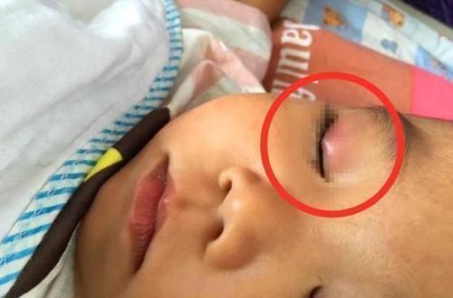 化学物质|3岁男孩将502滴入眼睛,奶奶的一个举动获医生称赞:姜还是老的辣