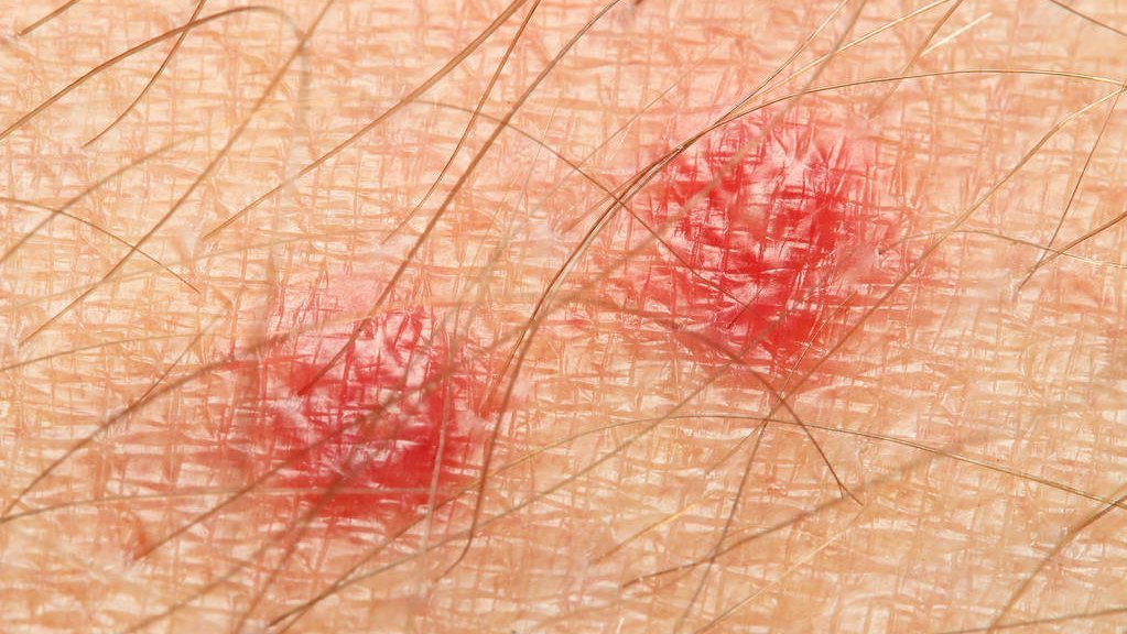 免疫系统|夏天被蚊子扰得不厌其烦?医生教你科学方法,轻松让蚊虫去咬别人