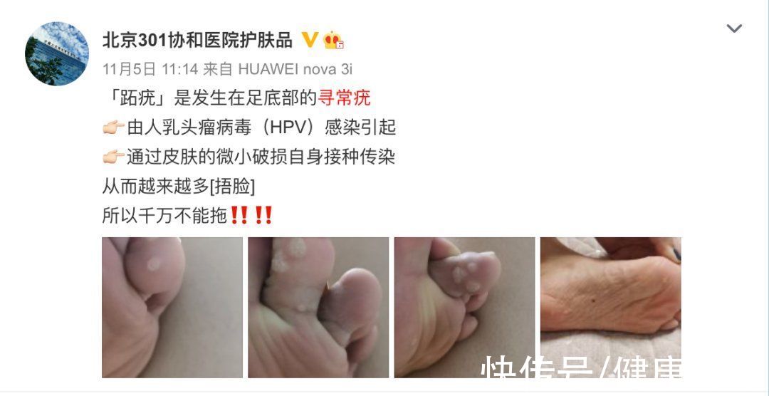 尖锐湿疣|身上莫名长出的"小肉揪揪",是感染了病毒?一篇文章全说清楚