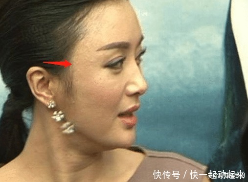 影响|爱挤痘痘的这些女星,现在皮肤都是什么样看这2个例子就知道了