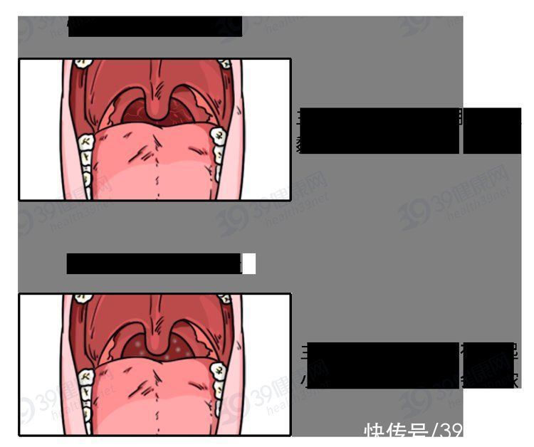 慢性咽炎|慢性咽炎总不好怎么办？这6味药要收好，肿痛、干痒可能就消失了