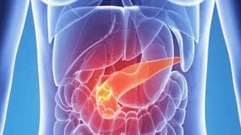 卡路里|胰腺癌到来时，身体会出现这7个表现，还请及时发现！