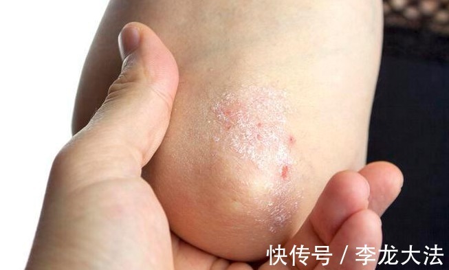 风湿病|医疗的真相：四种病无法完全治愈，不要被欺骗，落得个人财两空