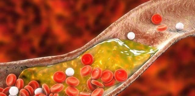 双腿|天然“溶栓剂”已揭晓,不是洋葱木耳,放肆吃,血管“畅通无阻”