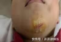 美容|孩子误吞硬币、意外受伤该怎么办?儿科医生提醒:这样做才正确