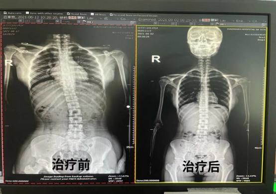 驼背|「健康」小小年纪出现高低肩、含胸驼背怎么办？预防方法看这里！