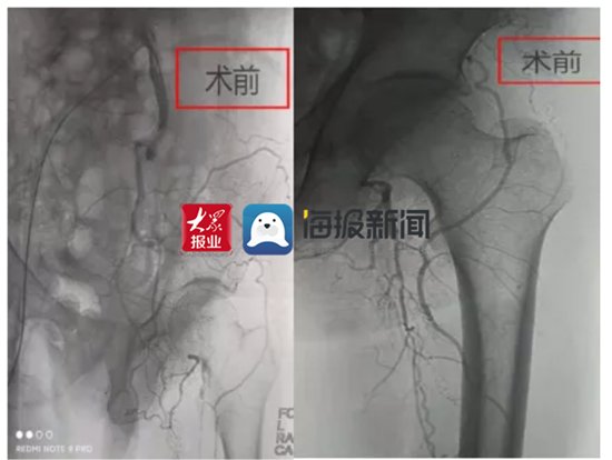 微创开通血管手到病除|万杰医院:七旬大伯腿痛难忍夜不能寐,介入微创开通血管手到病除