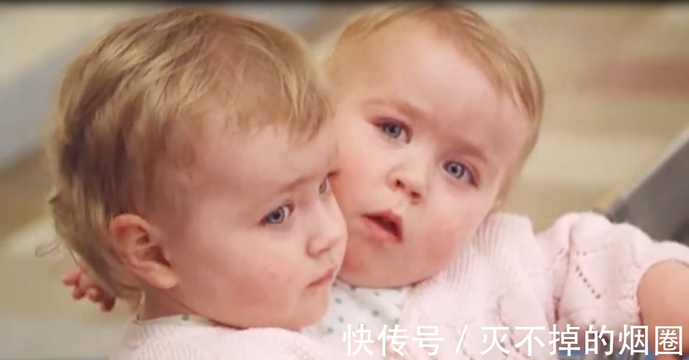 索菲亚|2女孩共用一个躯体生活3年,要将她们个体分离,能成功吗?