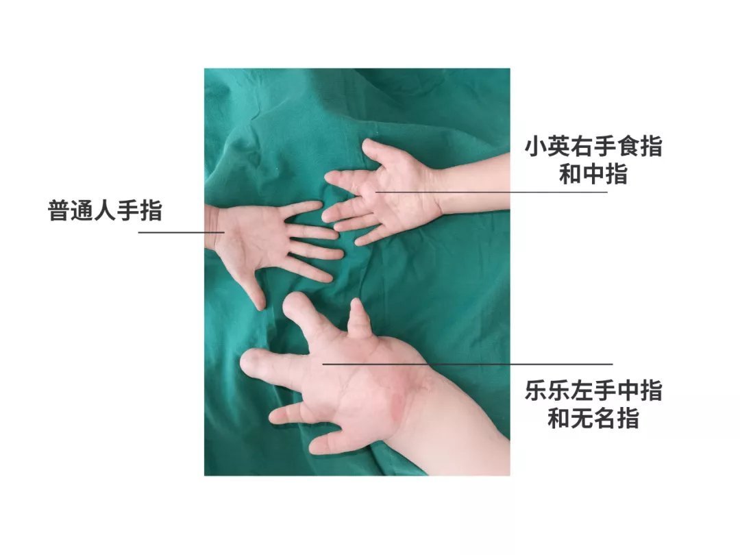 发育不良|得了这病,12岁男孩手指比香蕉还粗!7种常见的手部畸形,家长们要注意