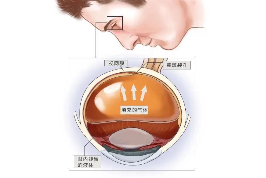 视网膜病变|什么？！玻切术后需要低头两个多月？