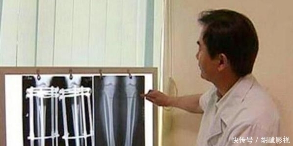 当年因身高矮自卑,花16万断骨增高72厘米的李亚诺,后来怎样