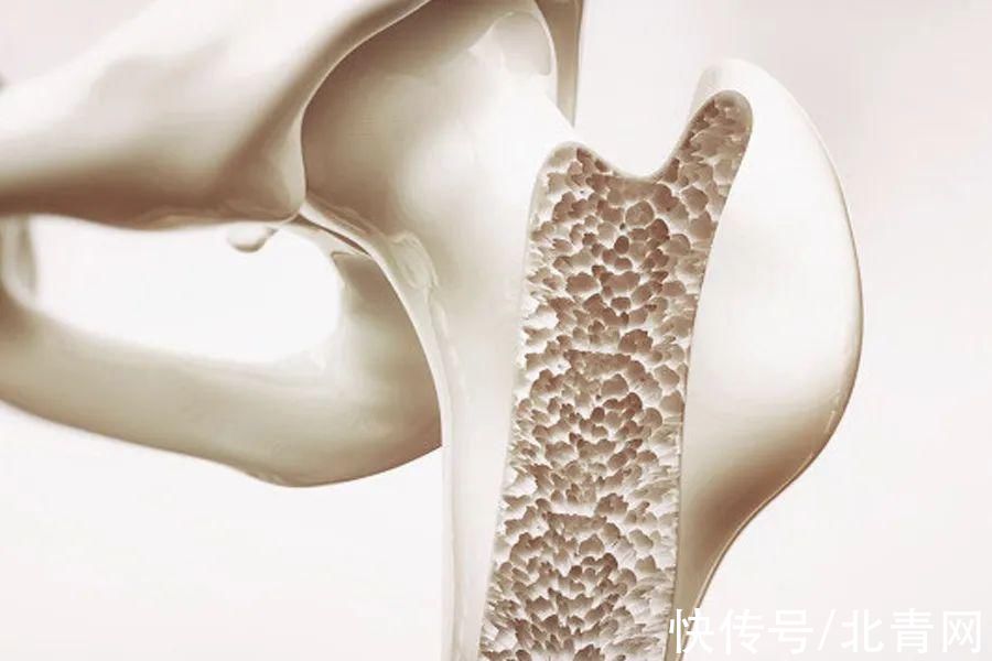 解析|骨质疏松骨折手术后就没事了吗？防治全解析
