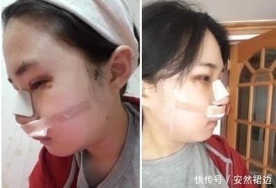 小脸确实更可爱,看完整容过程,只觉得满屏的疼痛