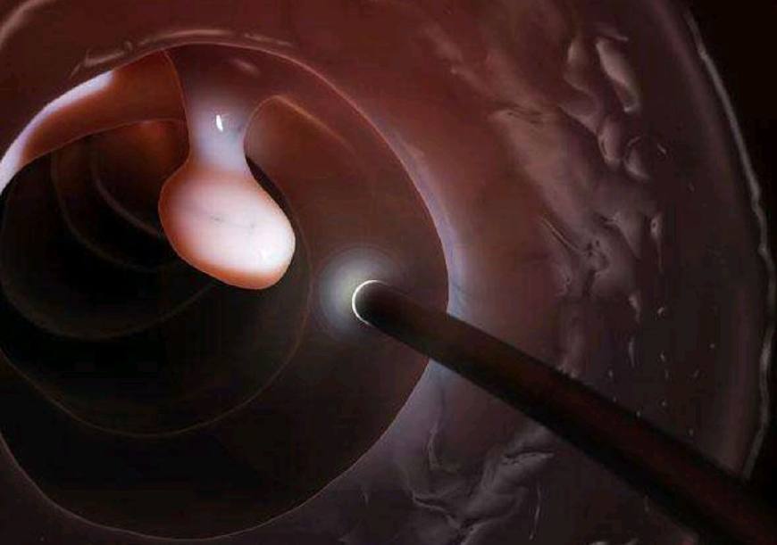 排便|为什么肠道“喜欢”长息肉可能和3个习惯有关,不妨多了解