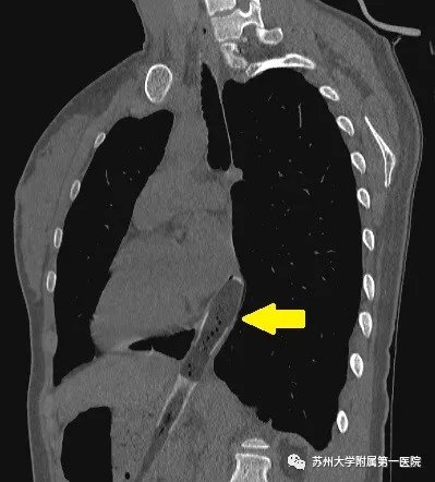 男子|男子用牙刷取异物，不成想误吞牙刷成更大异物