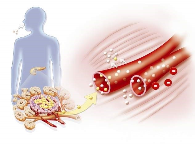 胰腺癌|女子口渴、尿多,以为是糖尿病,直到上腹部不适医生才发现是癌症