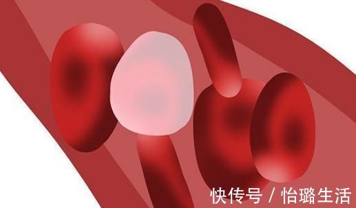 静脉曲张|无论男女，腿上若出现几种“迹象”，多半是体内有血栓了！