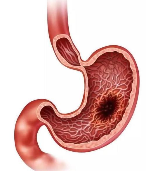 胃不好不能吃葡萄?消化科医生:想养胃,3种水果要少吃