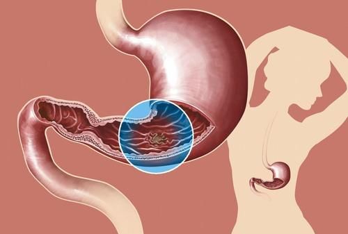 肠胃疾病|肠胃癌越来越多怎么办?早上两坚持,吃饭两不要,肠胃会更健康