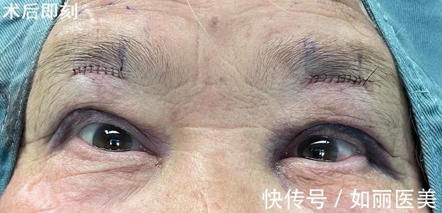 切口 双眼皮越宽眼睛就越大吗?医生揭开双眼皮手术的5个“真相”!