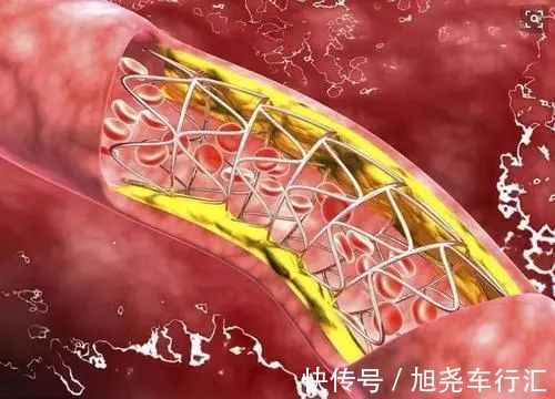 运动|血脂高不高,看小腿就懂?若有这4种症状,或在暗示血脂偏高了