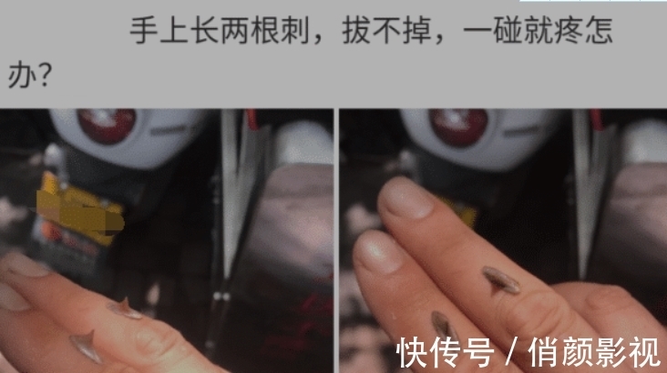 医院|“手上长了两根硬刺,去医院看什么科?”哈哈