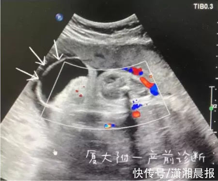 尾巴|崩溃！厦门一女子怀孕5个月，发现胎儿竟有“尾巴”