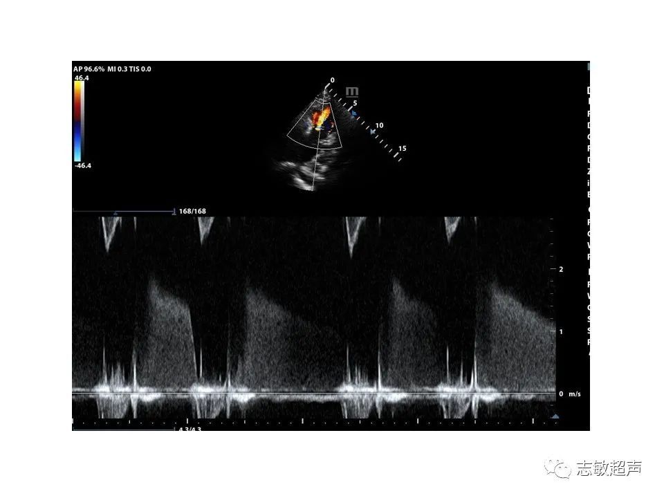 超声|肺动脉瓣周边异常血流的超声鉴别