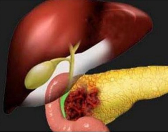 肝火|入睡难是肝火扰心,容易醒是心脾两虚,10种失眠类型,你属于哪种
