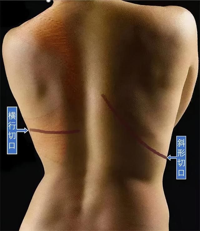 彤彤|20岁女大学生患乳腺癌左乳被切除，背阔肌华丽“转身”变漂亮乳房