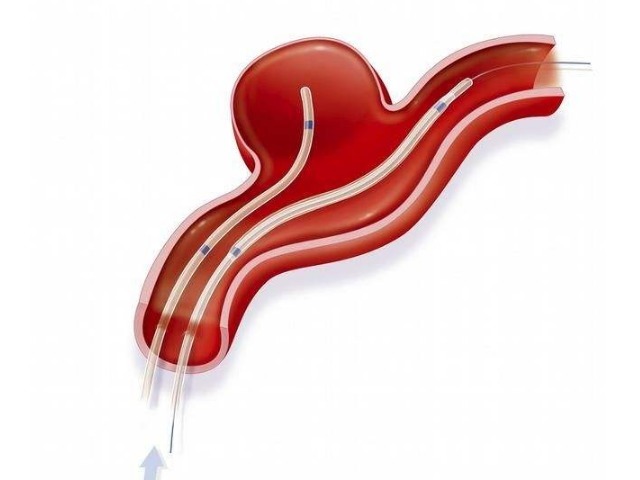 脚踝|血脂太粘稠,引起动脉硬化怎么办2个小动作帮你来搞定