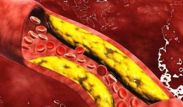 营养师|吃黑木耳能够降血脂、降血糖吗?营养师:一种木耳不可随意吃