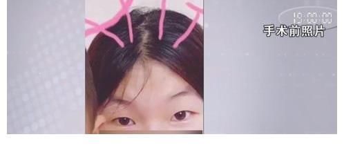 手术 28岁女子做双眼皮手术“眼睛变成白眼” 老公天天闹离婚