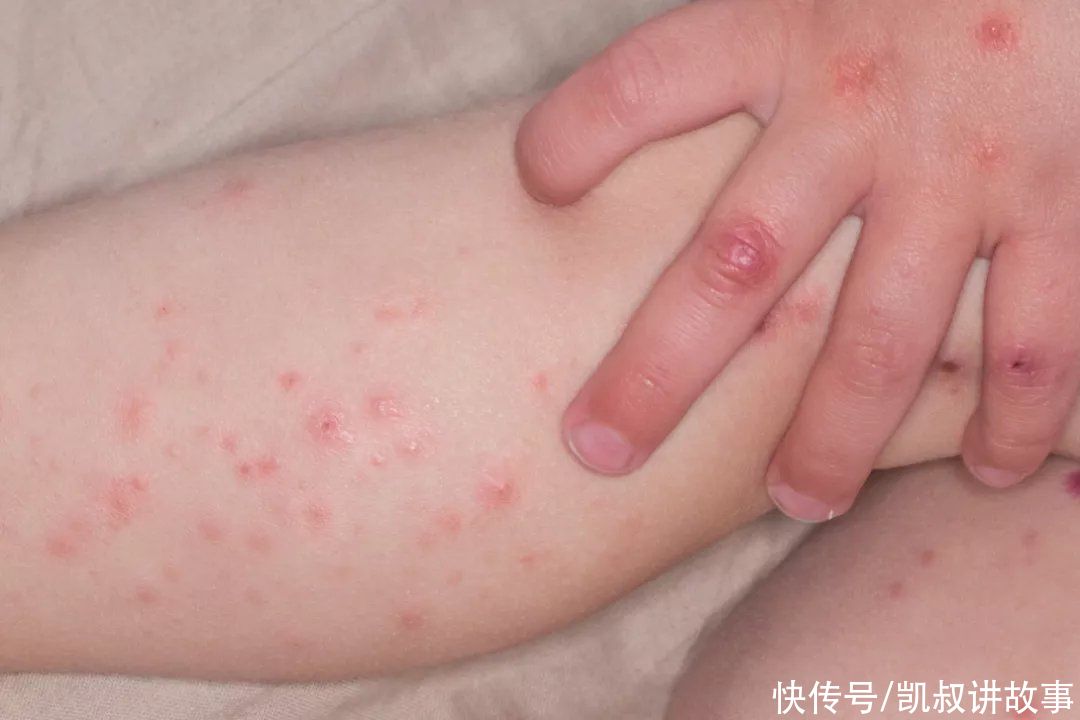 感染|这些“哄娃神器”也能感染“手足口病”，看看你家孩子在用吗？