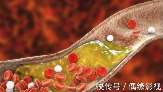 降脂|40岁男子吃素食降脂，血脂飙升，医生：3种“升脂素食”，劝少吃