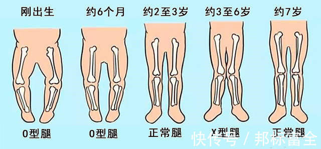 绑腿|这些育儿陋习可能导致孩子“小短腿”，别再让老人执迷不悟了