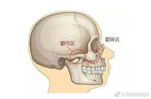 颧骨降低手术切口在哪，术后怎么护理?