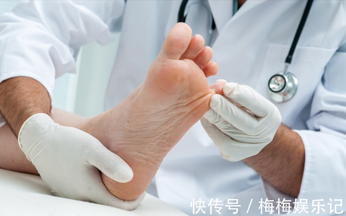 医生|得了灰指甲该怎么治?医生教你3个绝招,彻底搞定灰指甲不复发