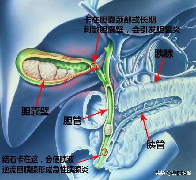 胆囊|岳阳市中医医院：警惕“沉默的杀手”胆囊结石