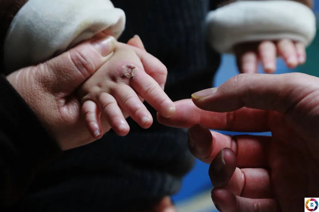 桐桐|漂亮女童身怀“特异功能”,没有痛觉,不会出汗,爸妈却因她流泪