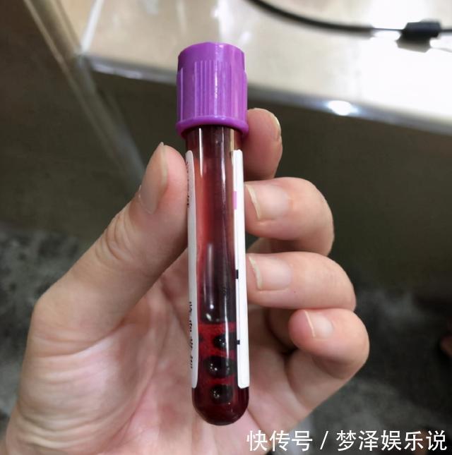 世界唐氏综合征日|世界唐氏综合征日:三类孕妇易怀“唐氏儿”,两项产检筛查很关键