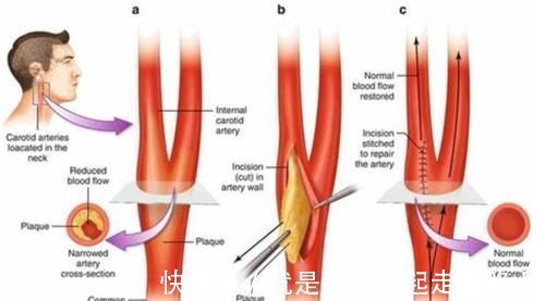 颈动脉|颈动脉有斑块,会有哪些症状?应该如何治疗?医生告诉你答案