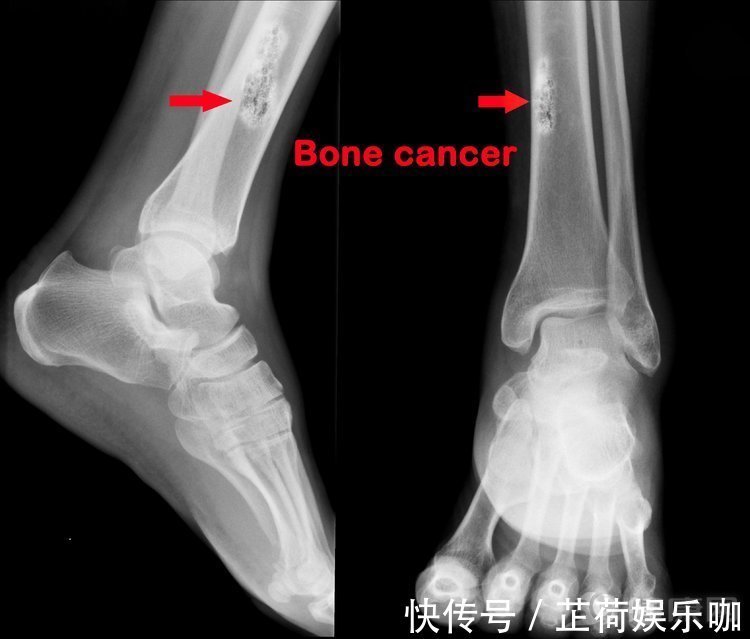 胆管癌|不瞒你说:最难治愈的癌症中,这5种“榜上有名”