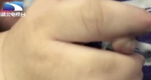 指头|罕见!新生儿有25根指头,一看到妈妈的手,医生瞬间明白了